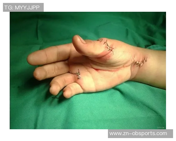 麦凯恩成功接受拇指韧带修复手术预计缺阵至少一个月 麦凯恩成功接受拇指韧带修复手术预计缺阵至少一个月